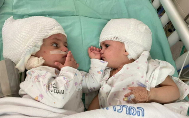 Conjoined twins, newly separated at Soroka University Medical Center in Beersheba, look at each other for the first time, on September 5, 2021. (courtesy of Soroka University Medical Center in Beersheba)